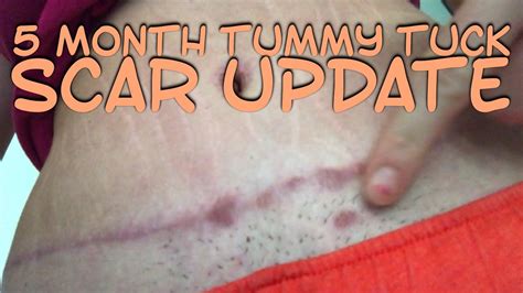The resulting scar is particularly visible at first, although it starts to gradually fade with time. . Infected belly button after tummy tuck